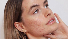 Как убрать акне с помощью корейской косметики: рабочие компоненты, схемы ухода и лучшие формулы